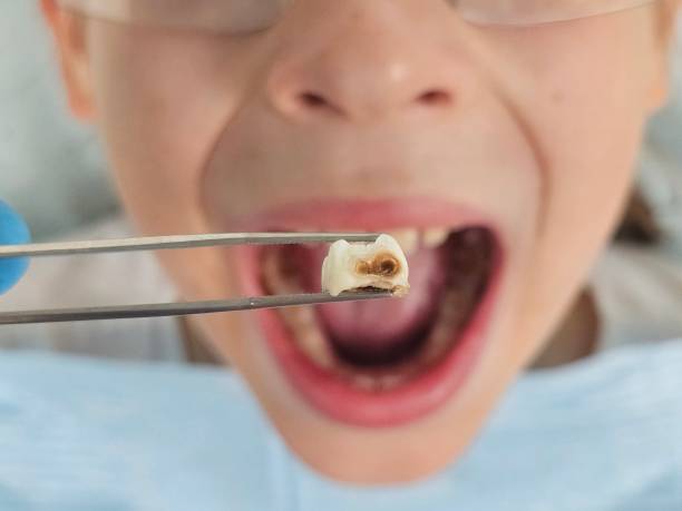 Best Emergency Dentist for Lost Fillings or Crowns in Dacula, GA
