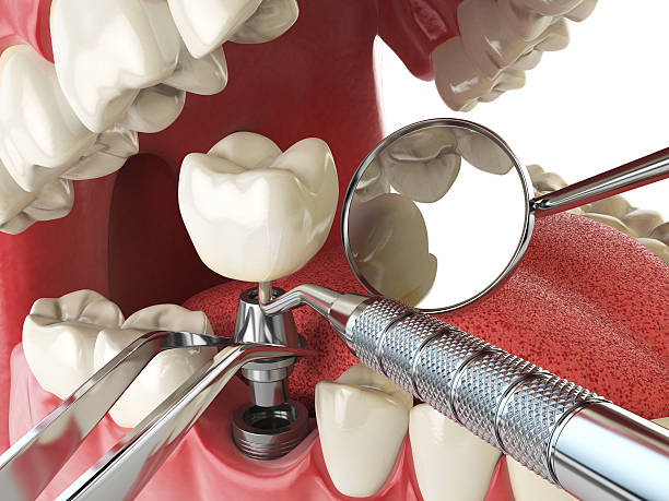 Best Broken or Cracked Tooth Emergency Dentist in Dacula, GA
