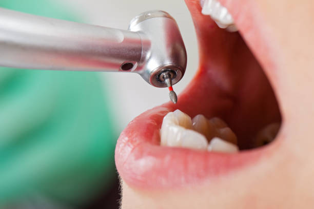 Best Emergency Dental Care for Abscessed Tooth in Dacula, GA